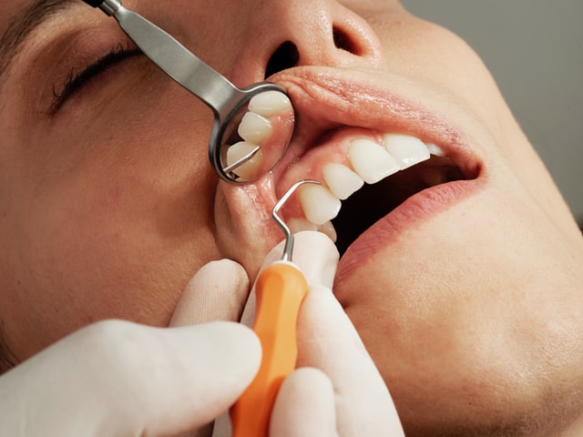Jak powstaje próchnica zębów?